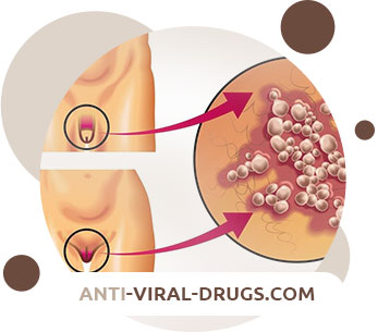 Genital herpes