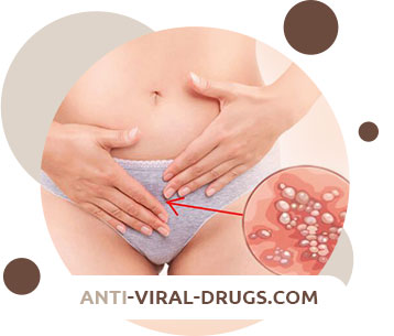 Genital herpes